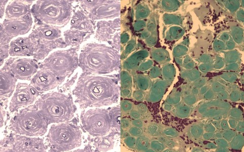CIDP with Onion Bulbs Nerve biopsy of a patient with CIDP showing onion bulb pathology