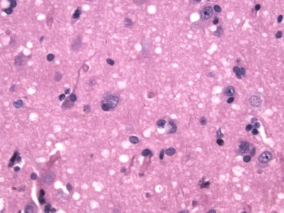 Spongiform Encephalopathy (CJD) H&E stain showing many small round vacuoles consistent with spongiform encephalopathy.