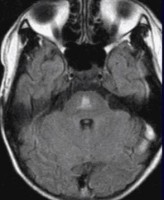 Axial cut MRI showing central pontine myelinolysis