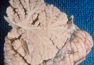 Cerebellar Atrophy Gross section of cerebellum with atrophy