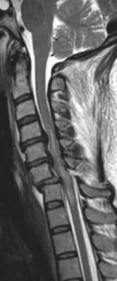 Spinal Cord Contusion Spinal Cord Contusion secondary to cervical spine fracture seen on MRI cervical spine, sagittal view