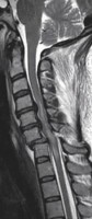Spinal Cord Contusion secondary to cervical spine fracture seen on MRI cervical spine, sagittal view