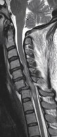Spinal Cord Contusion Spinal Cord Contusion secondary to cervical spine fracture seen on MRI cervical spine, sagittal view