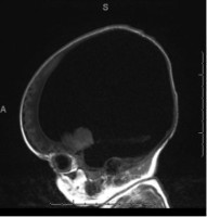 Sagittal MRI showing severe ventriculomegaly in a 37-week patient.