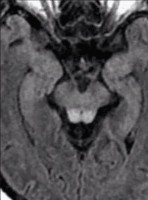 Axial cut MRI FLAIR sequence showing Wernicke encephalopathy evidenced by hyperintensity within the midbrain tectum