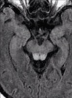 Wernicke's Encephalopathy (WE) Axial cut MRI FLAIR sequence showing Wernicke encephalopathy evidenced by hyperintensity within the midbrain tectum