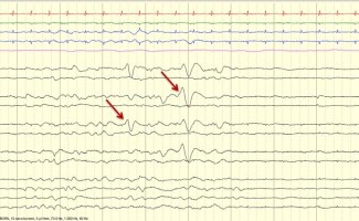 Frontal Sharp Transients Bilateral independent frontal sharps on neonatal EEG