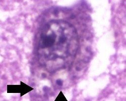 Granulovacuolar degeneration HIgh power H&E image showing intraneuronal accumulations of large vacuoles harboring a central granule. consistent with granulovacuolar degeneration