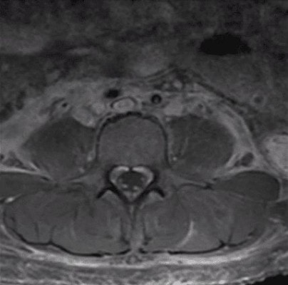 Guillain-Barre Syndrome Guillain-Barre Syndrome patient axial spinal MRI showing contrast enhancement of the cauda equina and nerve roots