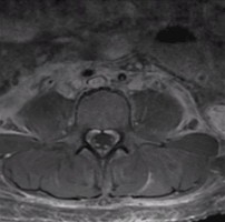Guillain-Barre Syndrome patient axial spinal MRI showing contrast enhancement of the cauda equina and nerve roots