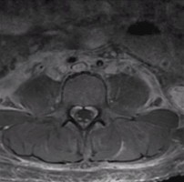 Guillain-Barre Syndrome Guillain-Barre Syndrome patient axial spinal MRI showing contrast enhancement of the cauda equina and nerve roots