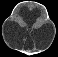 Aqueductal stenosis causing severe obstructive hydrocephalus on CT head