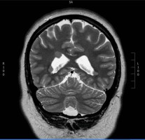 epilepsy patient with nodular heterotopia on coronal MRI brain