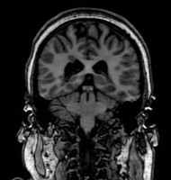 epilepsy patient with nodular heterotopia