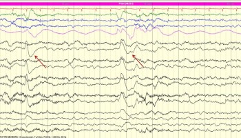 Hiccup Artifact Neonatal EEG with hiccups artifact