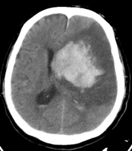 Intraparenchymal and intraventricular hemorrhage ICH CTH radiology images for neurology RITE exam
