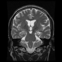 Coronal MRI with Left mesial temporal sclerosis