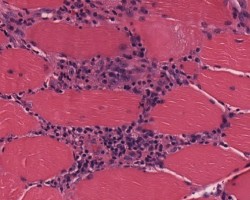 Polymyositis Polymyositis Muscle Biopsy slide for Neurology Board and RITE Practice Question Question Bank