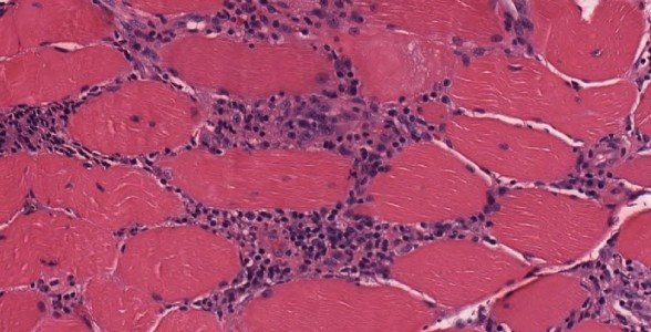Polymyositis Polymyositis Muscle Biopsy slide for Neurology Board and RITE Practice Question Question Bank