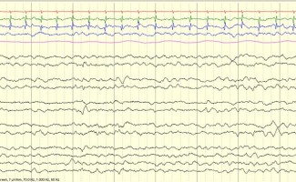 Normal Full-term Neonatal EEG Normal Full-term Neonatal EEG
