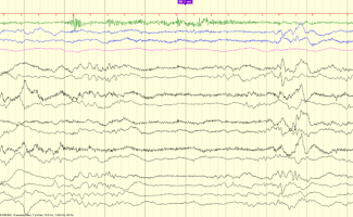 Trace Alternant (36-38 weeks) EEG review showing trace alternant