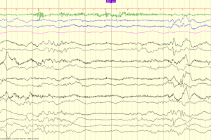 Trace Alternant (36-38 weeks) EEG review showing trace alternant