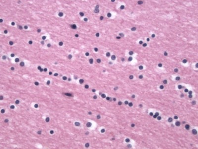 Normal Oligodendrocyte Normal Oligodendrocyte on pathology stain