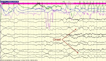 Patting Artifact Part 1