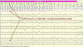 Patting Artifact Part 2