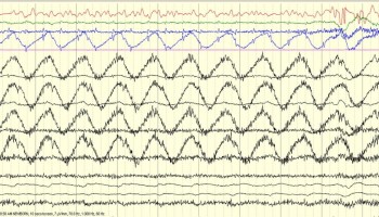 Respiration Artifact Respiration Artifact on EEG tracing