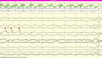 Sucking Artifact Sucking Artifact on EEG tracing