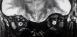 Optic neuritis Unilateral (left) optic nerve contrast enhancement, optic neuritis MRI