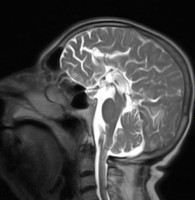 Sagittal MRI showing agenesis of the corpus callosum