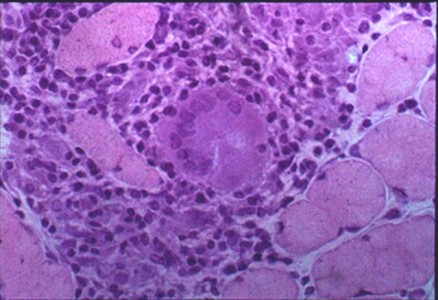 Sarcoidosis of Muscle A skeletal muscle biopsy H&E stain with a non-caseating granuloma and a multinucleated giant cell of sarcoidosis