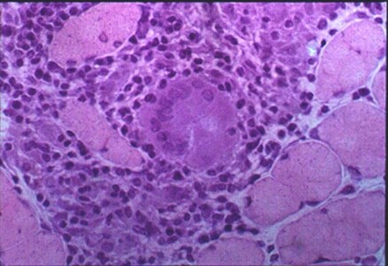 Sarcoidosis of Muscle A skeletal muscle biopsy H&E stain with a non-caseating granuloma and a multinucleated giant cell of sarcoidosis