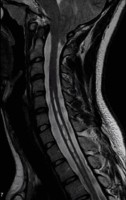 Syringomyelia (syrinx) seen on sagittal cervical spine MRI in a patient with Chiari 1 maformation