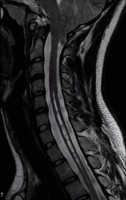 Spinal Syrinx and Chiari Malformation Syringomyelia (syrinx) seen on sagittal cervical spine MRI in a patient with Chiari 1 maformation