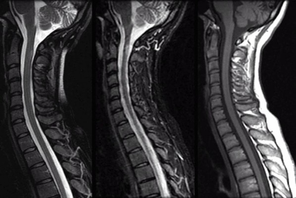 Multiple Sclerosis Sagittal spinal MRI of a patient with multiple sclerosis