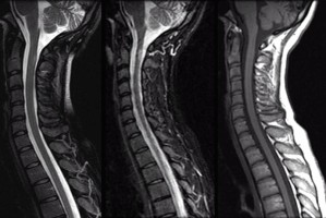 Sagittal spinal MRI of a patient with multiple sclerosis