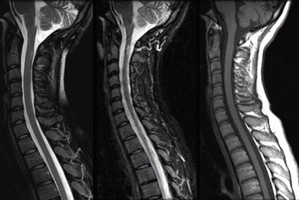 Multiple Sclerosis Sagittal spinal MRI of a patient with multiple sclerosis