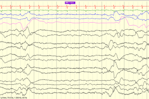 Trace Alternant EEG review tracing with trace alternant