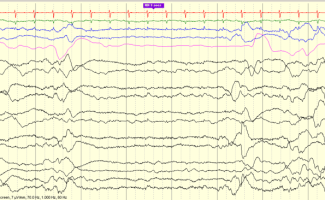 Trace Alternant EEG review tracing with trace alternant