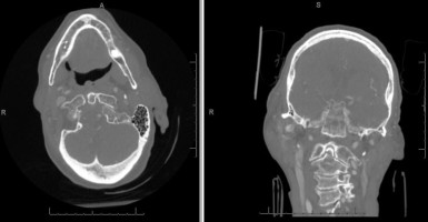 Type 1 Odontoid Fracture on axial and coronal CT head