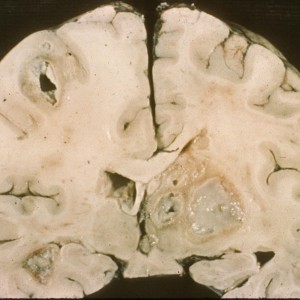 Brain Abscess Coronal section showing multiple well-circumscribed brain abscesses