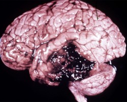 Acute Brain Contusion Acute brain contusion on gross pathology