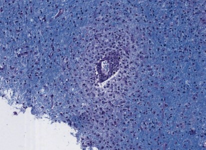Acute Disseminated Encephalomyelitis Acute Disseminated Encephalomyelitis Biopsy with perivenous infiltration of lymphocytes and demyelination