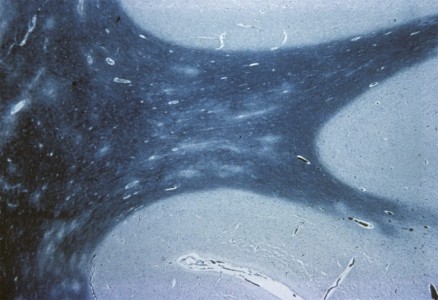 Acute Disseminated Encephalomyelitis Acute Disseminated Encephalomyelitis on brain biopsy Luxol fast blue stain, low power view, showing several pale demyelinated areas in the cortical white matter