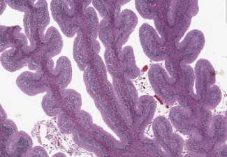 Cerebellar Atrophy Cerebellar atrophy on pathologic specimen