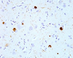 Lewy Bodies Immunostaining of alpha synuclein in Lewy Bodies and Lewy Neurites in the neocortex of a patient with Lewy Body Disease