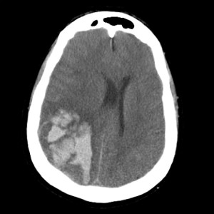 Intraparenchymal Hemorrhage from Amyloid Deposition Disease Intraparenchymal Hemorrhage from Amyloid Disease on axial CT head